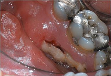 Osteoradionecrosis of the jaw: A mini review